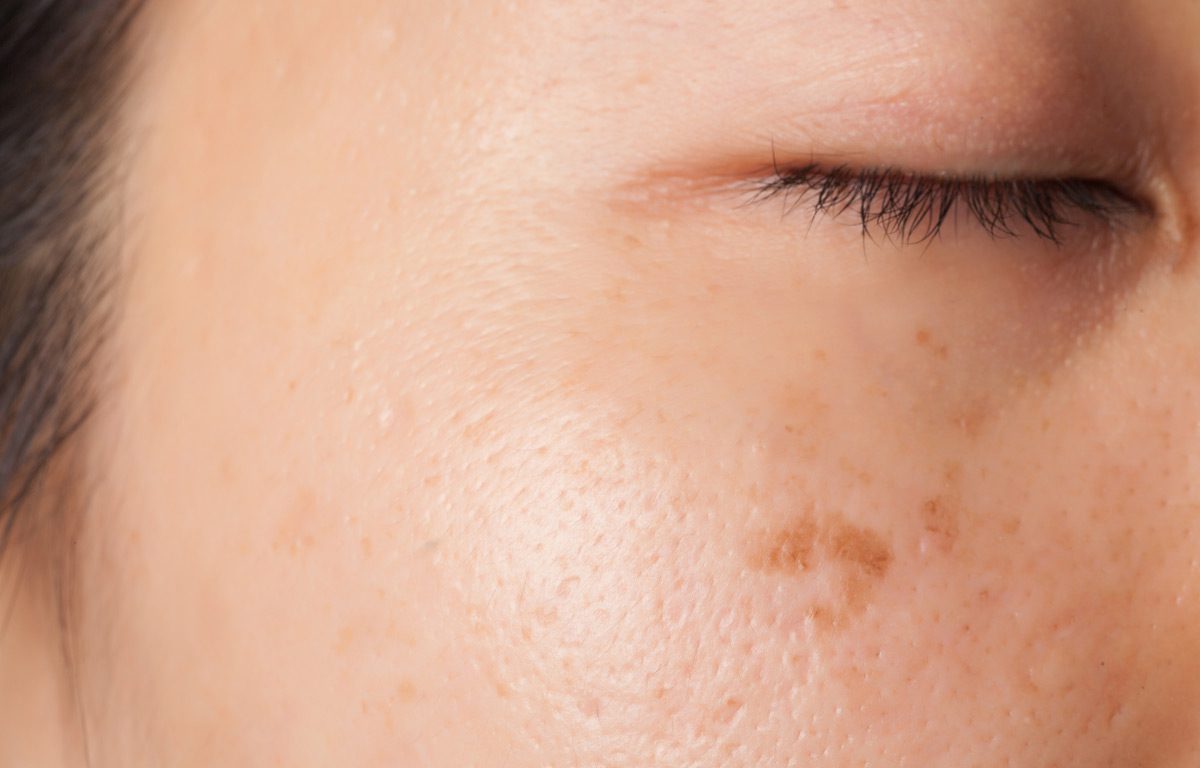 Acne-Scarring-and-Laser-Treatments-Silicon-Valley-Medical-Spa