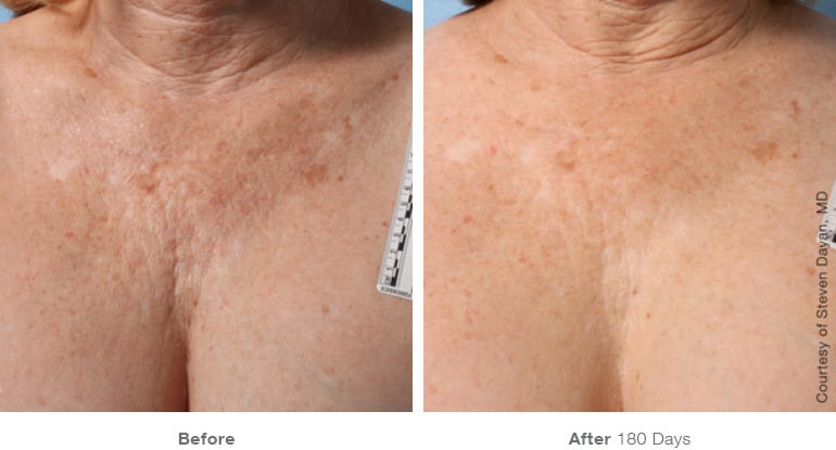 Ultherapy AB-1