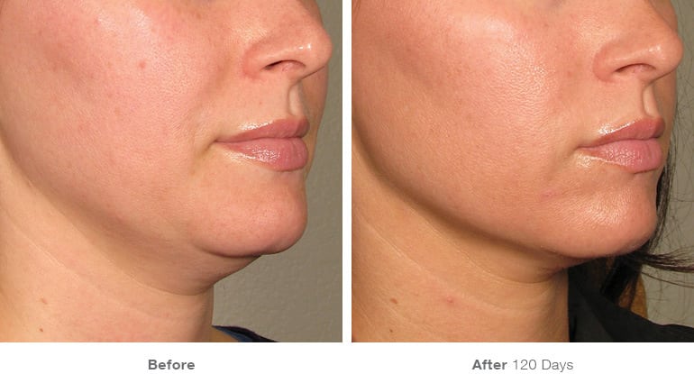Ultherapy AB-5