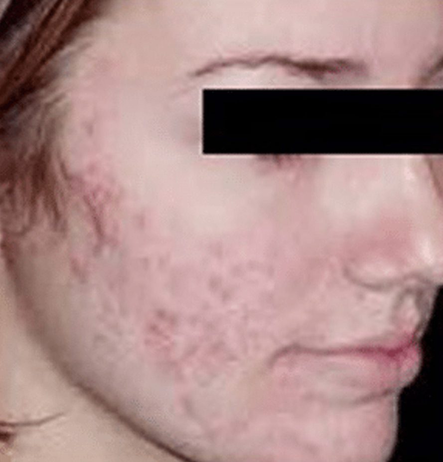 Acne2-before