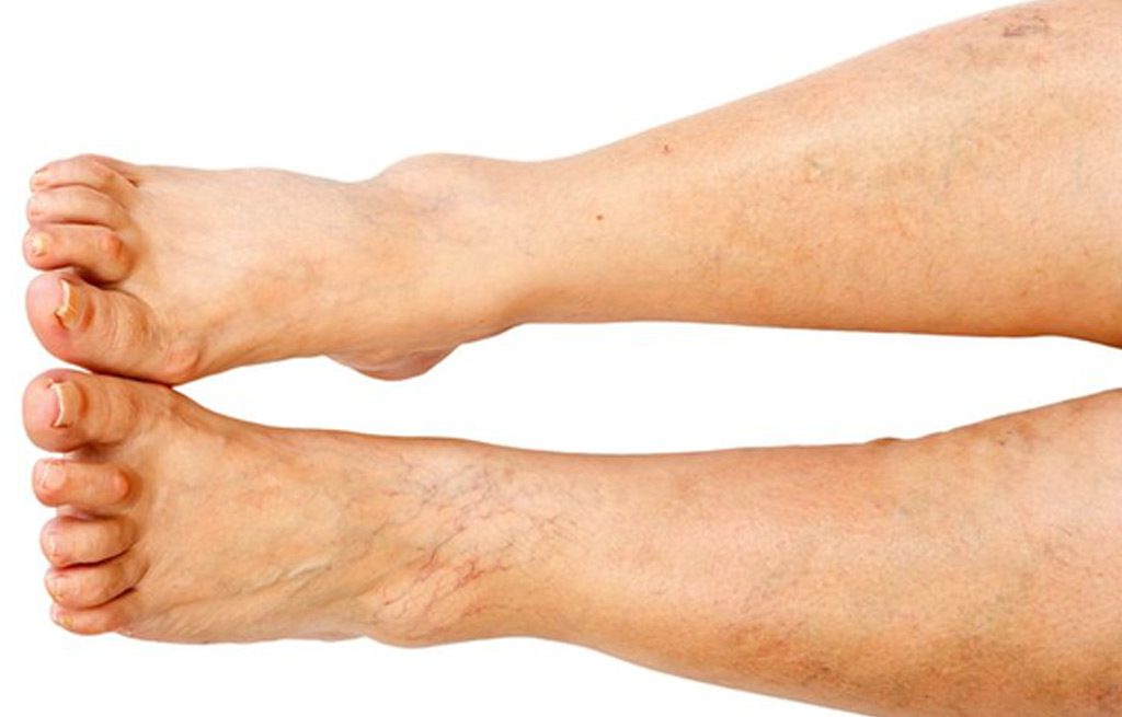 Laser-Vein-Removal-Silicon-Valley-Medical-Spa-1