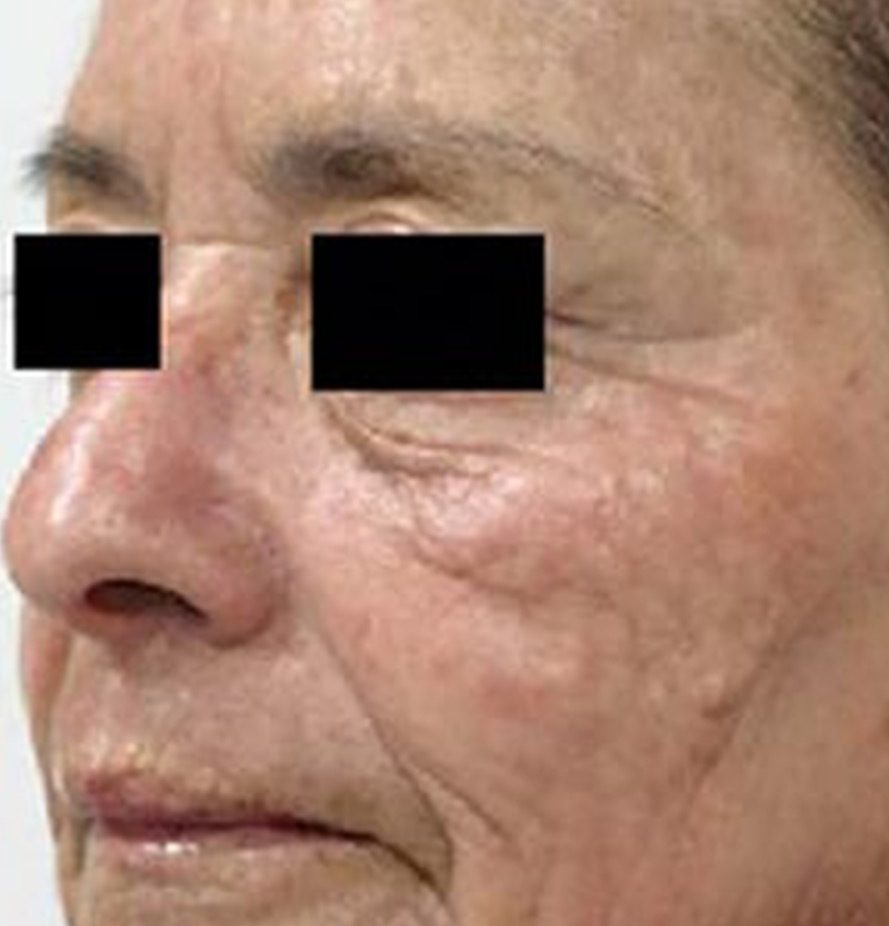 Pixel-Laser-Skin-Resurfacing1-after