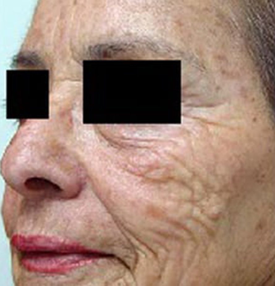 Pixel-Laser-Skin-Resurfacing1-before