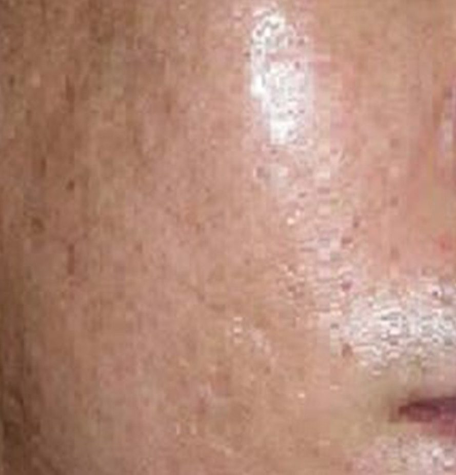 Pixel-Laser-Skin-Resurfacing3-after