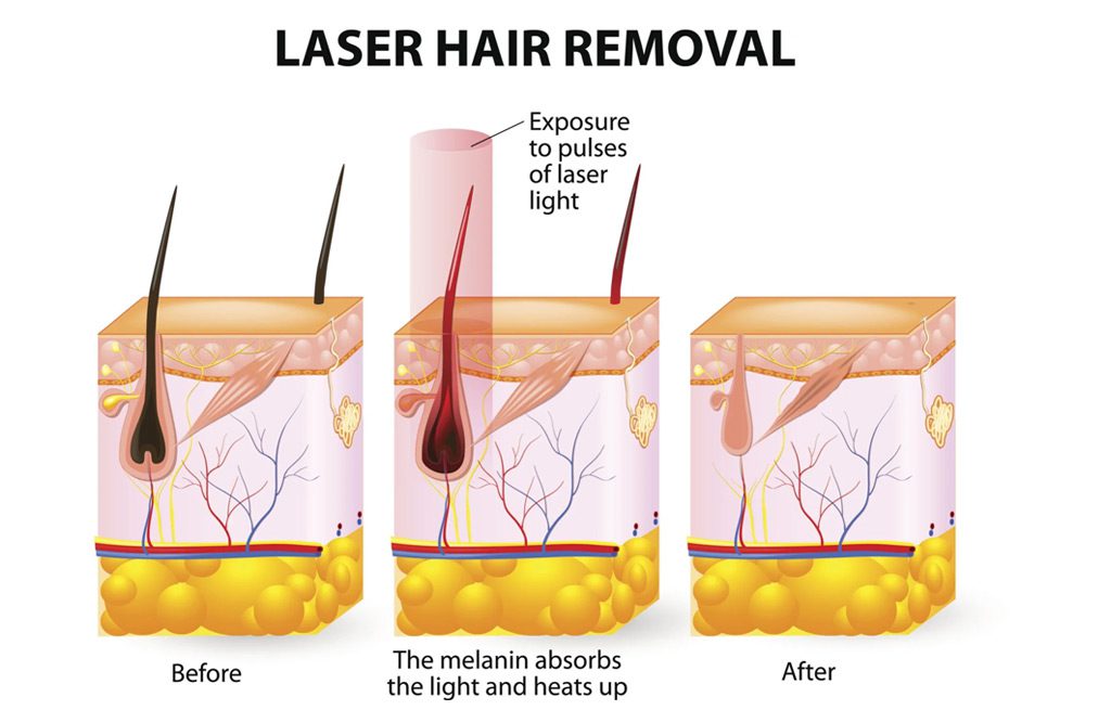 San-Jose-Laser-Hair-Removal-Silicon-Valley-Medical-Spa-2