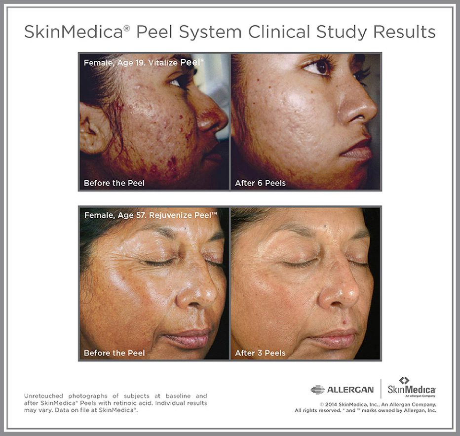SkinMedica-Peel-System-Clinical-Study-Results