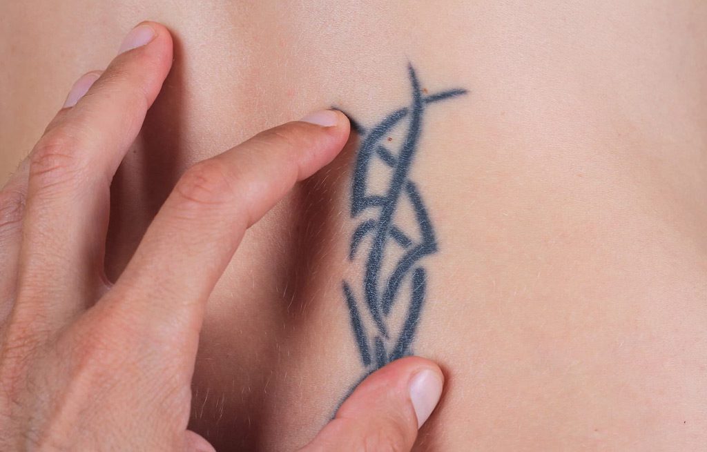 Tattoo-Removal-Cost-Silicon-Valley-Medical-Spa-1