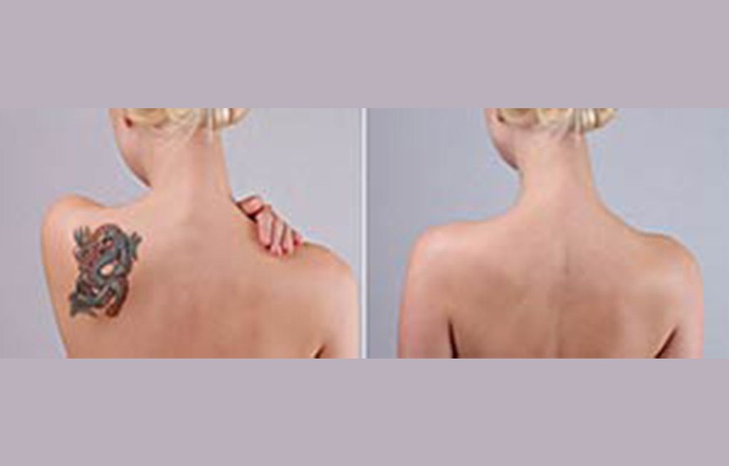 Tattoo-Removal-Cost-Silicon-Valley-Medical-Spa-3