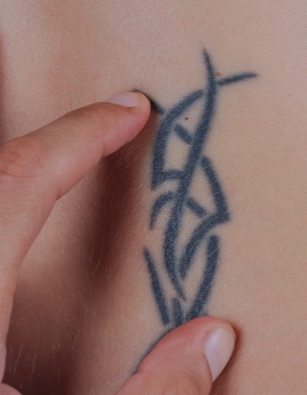 Tattoo-Removal-Cost-Thumb