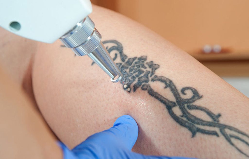 Tattoo-Removal-Silicon-Valley-Medical-Spa-1