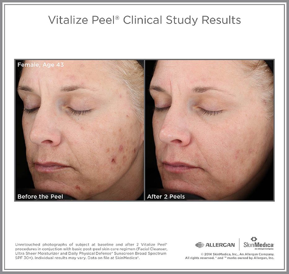 Vitalize-Peel-Clinical-Study-Results