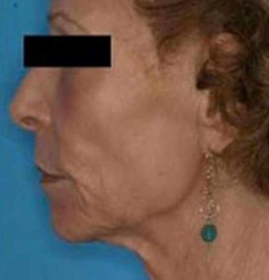 eCO2-Ablative-Laser-Resurfacing1-after