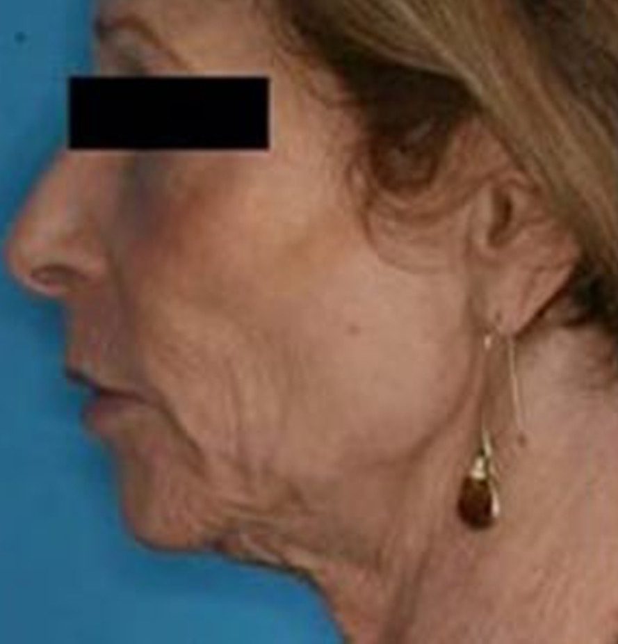 eCO2-Ablative-Laser-Resurfacing1-before