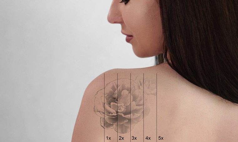 stages-of-laser-tattoo-removal